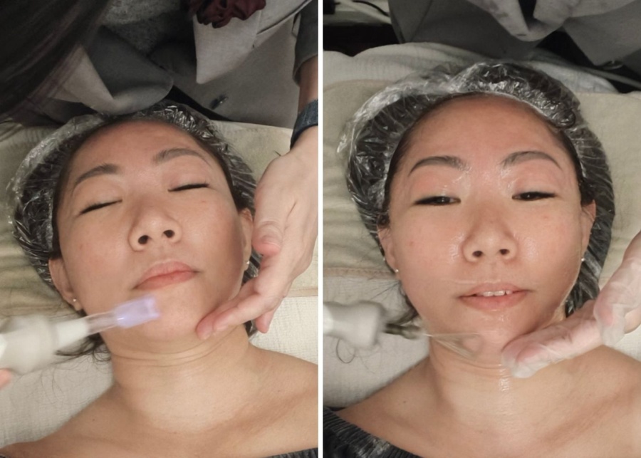 Roses & More Skin Alchemy dual plasma treatment